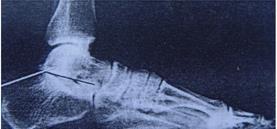 Kiểm tra góc Bohler trong khoảng 25-40. Xuyên đinh Steinmann qua phần xương gót đã nắn cắm vào xương bàn.