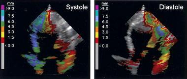 TISSUE TRACKING Đánh giá vận động vùng cơ tim dựa trên vận tốc của mô cơ tim, được mã hoá màu tự động.