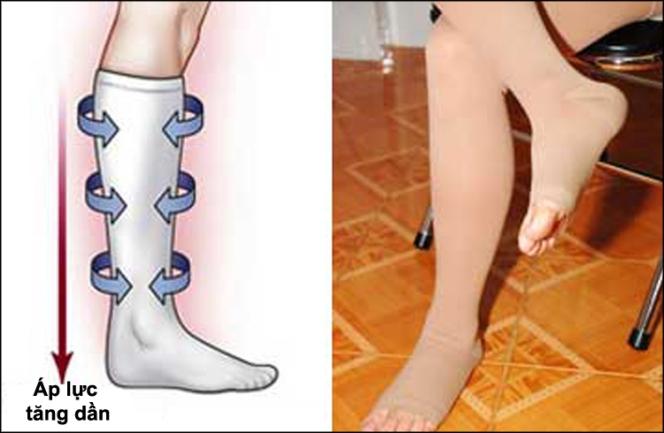 Cục máu đông: đôi khi các tĩnh mạch nằm sâu bên trong chân trở nên lớn hơn và chân có thể sưng to.