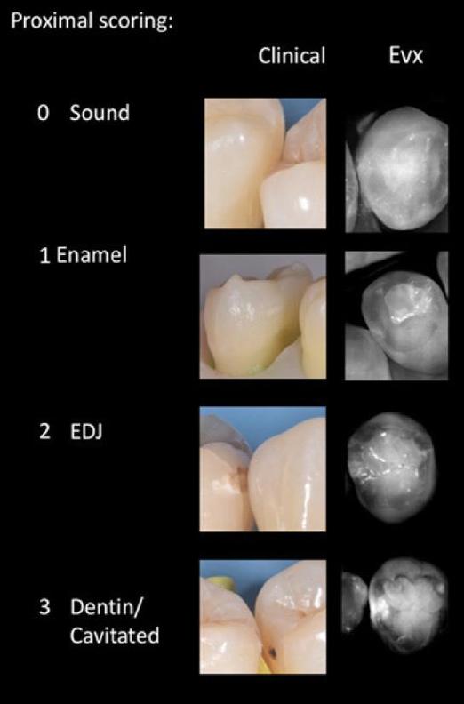 Sâu răng ở đầu gần Hệ thống chấm điểm được cung cấp theo tiêu chuẩn ICDAS-II Men răng khỏe mạnh sẽ hiện ra mà không có bất kỳ vết sáng đáng chú ý nào, có nghĩa là nó sẽ giống như một vòng tối bao
