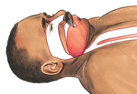 Airway Obstruction Most common