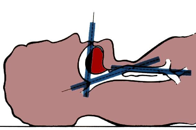 Aligning Axes of Upper Airway A Mouth B A B