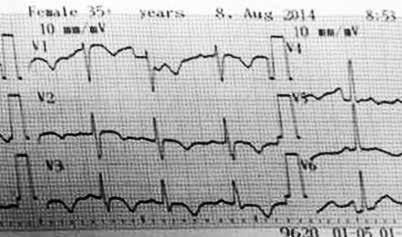Bệnh nhân được làm một số thăm dò khác, trong đó có điện tim lần thứ 2 xuất hiện dấu hiệu thay đổi mới so với điện tim lúc vào viện: Nhịp nhanh, Tâm ở DIII và V1 đến V3.