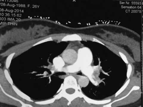 phải cấp. Chỉ định chụp cắt lớp vi tính (CLVT) động mạch phổi cấp cứu được xem xét.